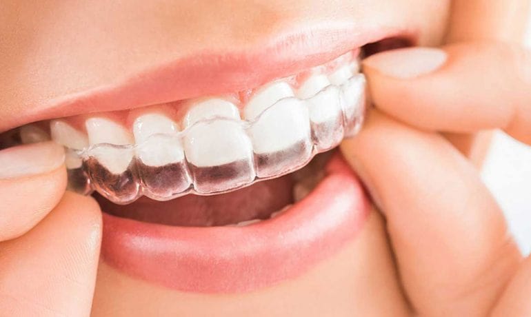 町田の矯正歯科が解説、ワイヤーやインビザライン、歯列矯正の種類って？