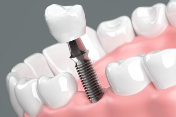 町田のインプラント専門医が解説。歯が抜けた時の３つの治療法と、インプラントの特徴