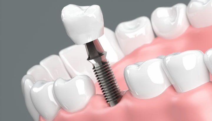 町田のインプラント専門医が解説。歯が抜けた時の３つの治療法と、インプラントの特徴