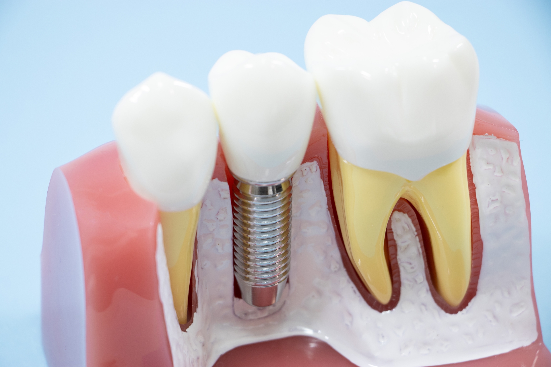 インプラントの手術の流れと術後ケアを徹底解説｜町田駅前クリスタル歯科